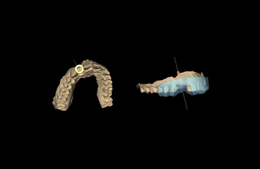 Využitie 3D tlače v stomatológii